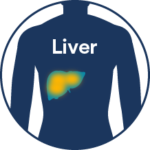 liver cancer