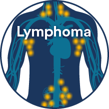 lymphoma